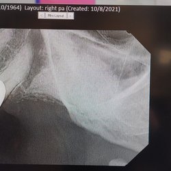 The Art Of Smiles Dental Group - Add bone with CGF bone graft