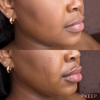UPKEEP - LIP FILLER - Medical Spas Near Me - New York, New York