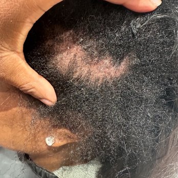 Salon DLM - Bald spot post microlinks - Makeup Artists Near Me - Temecula, California Salon DLM - Bald spot post microlinks - Makeup Artists Near Me - Temecula, California