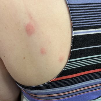 Big Cypress Lodge - Even more bed bug bites - Hotels Near Me - Memphis, Tennessee Big Cypress Lodge - Even more bed bug bites - Hotels Near Me - Memphis, Tennessee