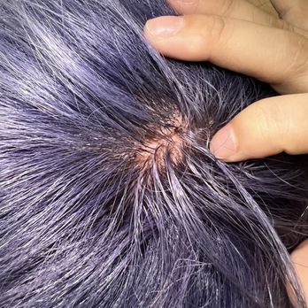 No1 Salon - Scalp swelling, itching, pus - Hair Salons Near Me - Chicago, Illinois