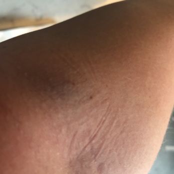 Quest Diagnostics - 10 minutes after blood draw, blowing my vein and having to switch arms! - Laboratory Testing Near Me - Atlanta, Georgia