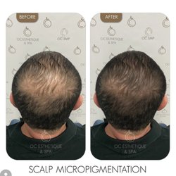 OC Esthetique and Spa - Scalp Micro Pigmentation
