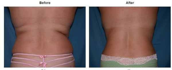 Photo of Suzanne Quardt MD - Palm Desert Plastic Surgery - Rancho Mirage, CA, US. Plastic Surgery Before & After Pictures https://palmdesertplasticsurgery.com/photo-gallery/