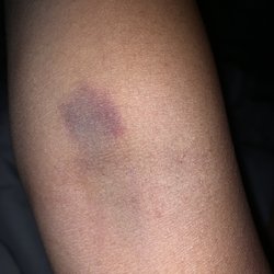Pro Vac Services - I got this bruise from my blood test I did previously the past week, I'm so disappointed with the lady that took my blood. First time