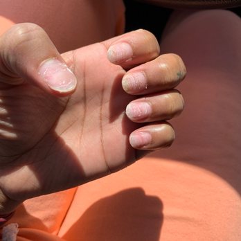 Fresher Nails & Spa - Left hand after removed at another salon - Nail Salons Near Me - Stockton, California