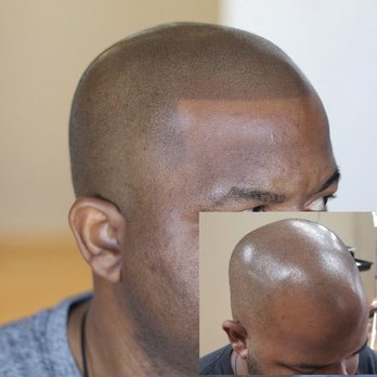 Scalp Micropigmentation - Any hairline you could dream of we got you COVERED. LITERALLY - Hair Loss Centers Near Me - Kensington, Maryland