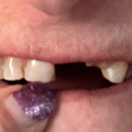 Tooth on left ripped out by surgeon on right the root canal crown broke at gum line. Tooth on left ripped out by surgeon on right the root canal crown broke at gum line.