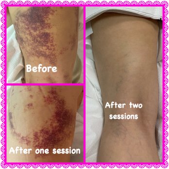 Zen Wellness By Cecily - My before and after pics. Very pleased with my results. - Colonics Near Me - Chino Hills, California