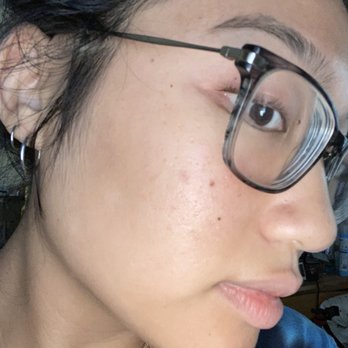 LC INK & SKIN - Here is my skin now! There's no sign of my previous acne scars and inflammation AT ALL - Skin Care Near Me - Montebello, California LC INK & SKIN - Here is my skin now! There's no sign of my previous acne scars and inflammation AT ALL - Skin Care Near Me - Montebello, California