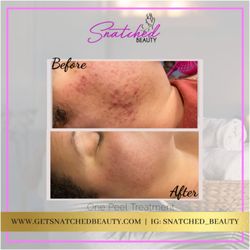 PCA Peel for acne & hyperpigmentation