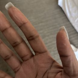 Peeling skin from acetone Peeling skin from acetone