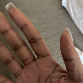 Star Nail Lounge - Peeling skin from acetone - Nail Salons Near Me - West Des Moines, Iowa Star Nail Lounge - Peeling skin from acetone - Nail Salons Near Me - West Des Moines, Iowa