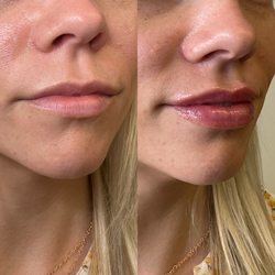 Raine Aesthetics & Wellness - 1 syringe Lip Filler Before/After
