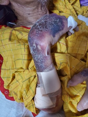 Photo of Regional Medical Center - San Jose, CA, US. Close up of the injuries he sustained from being pulled by the hospital staff