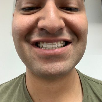 Sachdeva Orthodontics - Braces off - Orthodontists Near Me - Madera, California
