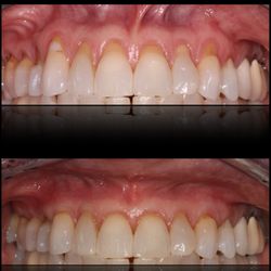 Vahe Nakashyan, DDS MDS - Gum graft to cover roots due to receding gums, using the least invasive and most time-tested technique. Multiple teeth can be done in 1 day.