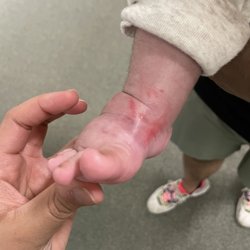 Scheck & Siress - Results of the boots being too tight.