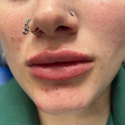CoCoAesthetic - 1 ML of filler top and bottom