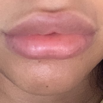 Wellness Med Art - My after picture. Both injectors did my lips. Ama did the first session on the top lip. Notice how the left side is grossly over filled - Medical Spas Near Me - Forest Hills, New York Wellness Med Art - My after picture. Both injectors did my lips. Ama did the first session on the top lip. Notice how the left side is grossly over filled - Medical Spas Near Me - Forest Hills, New York
