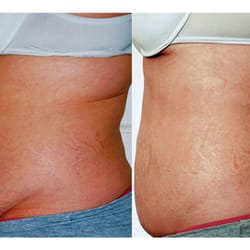 LiLa Body Contouring - Before & After - 8 sessions