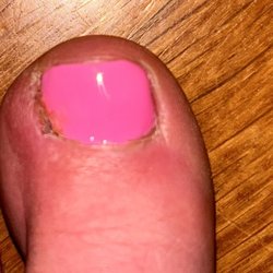 Luxury Spa & Salon - Infected toe