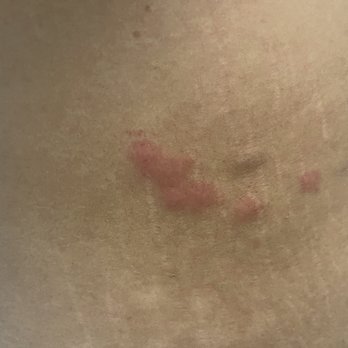 La Quinta by Wyndham Oklahoma City - Moore - Bed bug bites - Hotels Near Me - Moore, Oklahoma