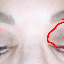 Skin still hanging after an upper bleph. No answers,  call back or email returned.