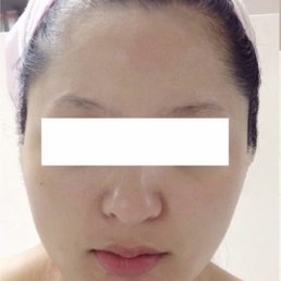 V-lifting after V-lifting after