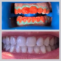 The Bright Spot - Teeth Whitening - During & after!