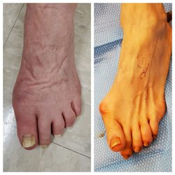 Advanced Foot and Ankle Center of San Diego - Before and after Bunion Correction minimal incision