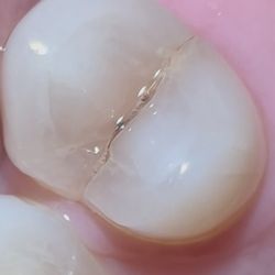 Blowe Family Dentistry - My tooth that needs a "root canal" broke. Completely in two.