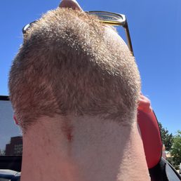Razor burn