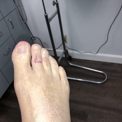 Daniel E Recalde, DPM - OC Advanced Foot Care - Hammertoe correction after surgery by Dr Recalde