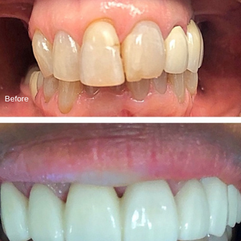 Davidson Dental Group - Before and after crowns by Dr. Davidson - General Dentistry Near Me - San Leandro, California Davidson Dental Group - Before and after crowns by Dr. Davidson - General Dentistry Near Me - San Leandro, California