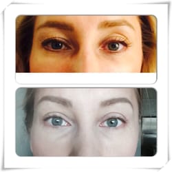 Peter Levin, MD - Before and after. Upper eye bleph