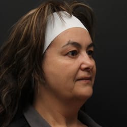 Miller Cosmetics - Lower Face/Neck Lift w/ Lipocontouring of jawline/neck, Fat Transfer to Lower Eyes, Upper Blepharoplasty Before