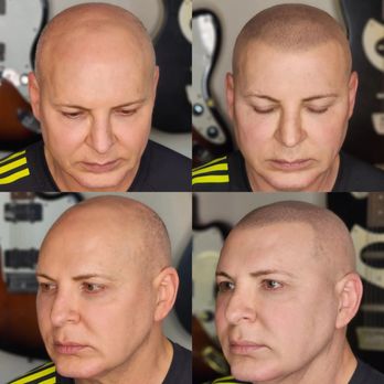 Real Time Results - Client is 63 years old. Pain level was a 1-2 depending on the area. - Hair Loss Centers Near Me - Boise, Idaho Real Time Results - Client is 63 years old. Pain level was a 1-2 depending on the area. - Hair Loss Centers Near Me - Boise, Idaho