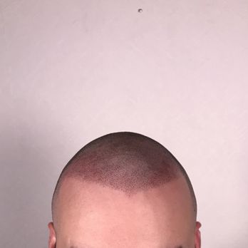 The Scalp Shop | New York Scalp Micropigmentation - Hairline. Right side is much higher. - Hair Loss Centers Near Me - New York, New York The Scalp Shop | New York Scalp Micropigmentation - Hairline. Right side is much higher. - Hair Loss Centers Near Me - New York, New York