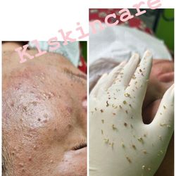 KL Skincare & Cosmetics - Acne treatment