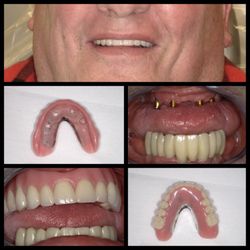 Chad Lyew, DDS - Alemany Dental - Removable implant-supported upper denture