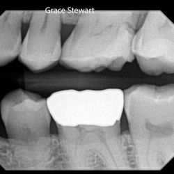 Associated Dentists - X-Ray of the upper tooth before Dr. Butkus does his work.