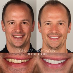 Orange and Magnolia Dental Studio - 10 porcelain veneers by Dr. Kahng for a brighter rejuvenated smile