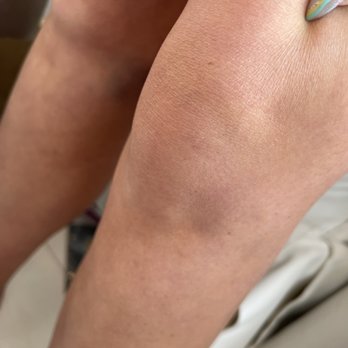 Club Space - My knee after falling down the stairs after pushed - Dance Clubs Near Me - Miami, Florida