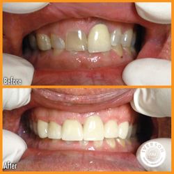 Iverson Dental Labs - A close-up of a patient with chipped and discolored teeth, now radiating confidence with perfectly restored, white, and smoot...