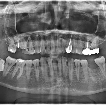 Cedar Park Dental Wellness - Before the wisdom tooth was removed on the right side of the pic - General Dentistry Near Me - Cedar Park, Texas
