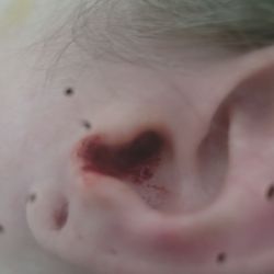Brunswick Medical Center - Her removing ear wax