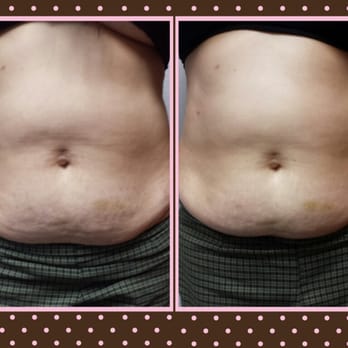 NatSkinCare - Cavitation with Farradic. Melting the Fat and toning the muscles. This is One Treatment . - Skin Care Near Me - Las Vegas, Nevada NatSkinCare - Cavitation with Farradic. Melting the Fat and toning the muscles. This is One Treatment . - Skin Care Near Me - Las Vegas, Nevada