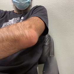 Valley Immediate Care - Swollen, infected bursa.