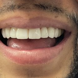 Crossroads Dental Group - Venners done with minimal drilling.